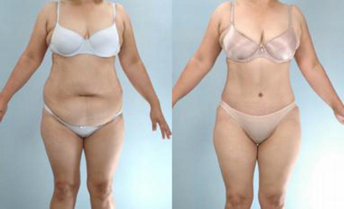 Before & After Liposuction Case 3391 View 1 View in Houston, TX