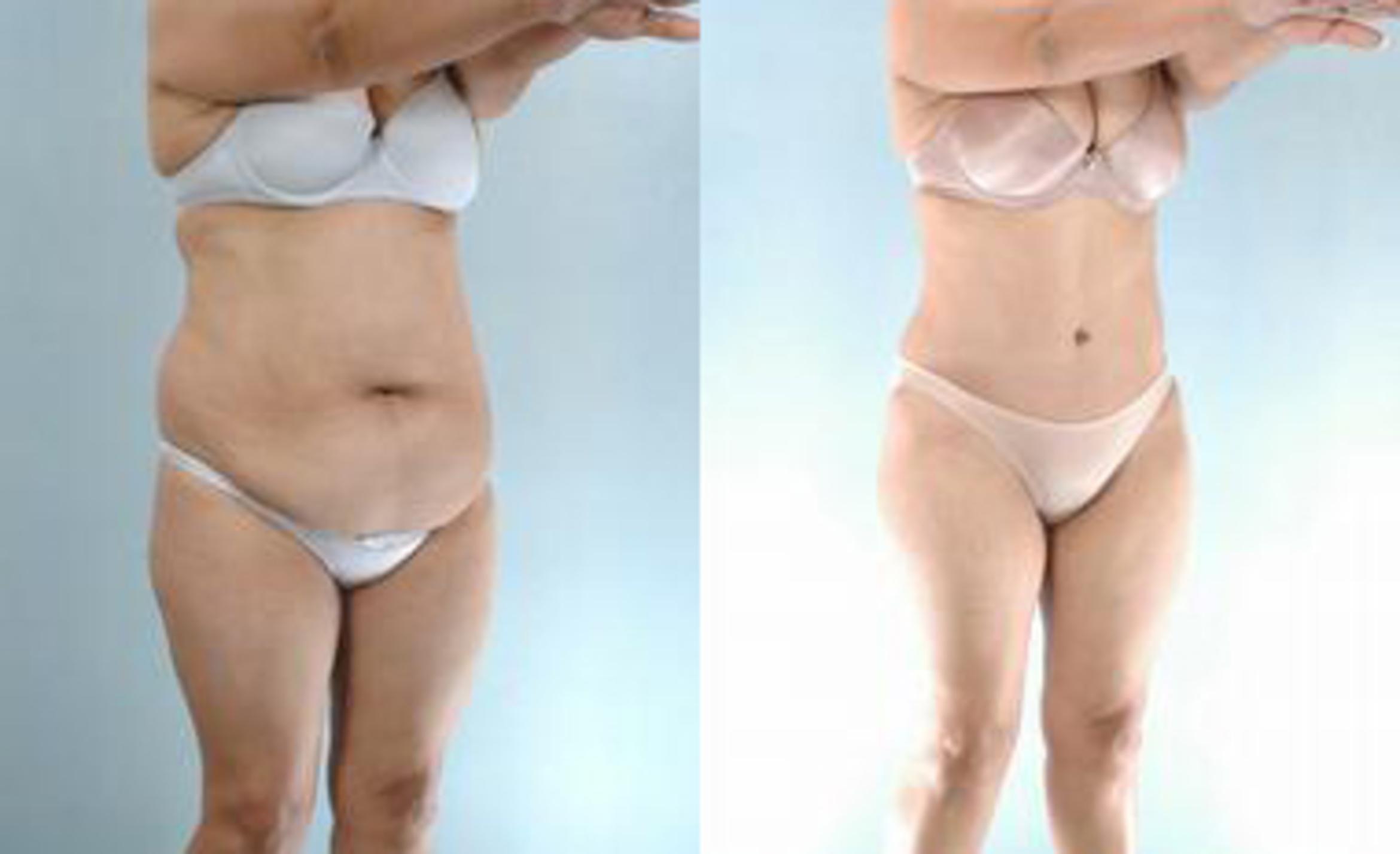 Before & After Liposuction Case 3391 View 2 View in Houston, TX