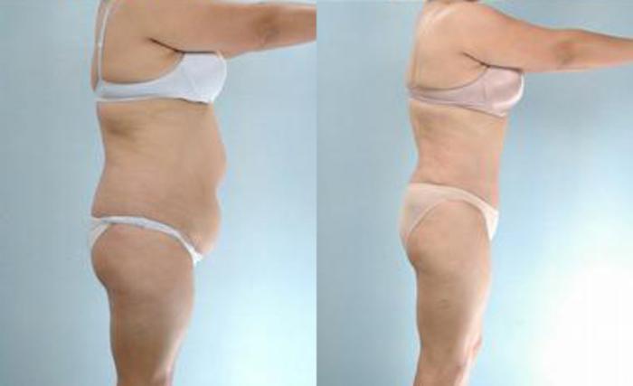 Before & After Liposuction Case 3391 View 3 View in Houston, TX