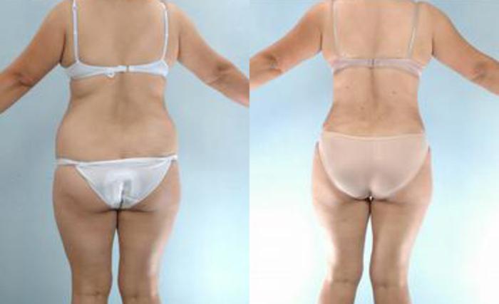 Before & After Liposuction Case 3391 View 4 View in Houston, TX