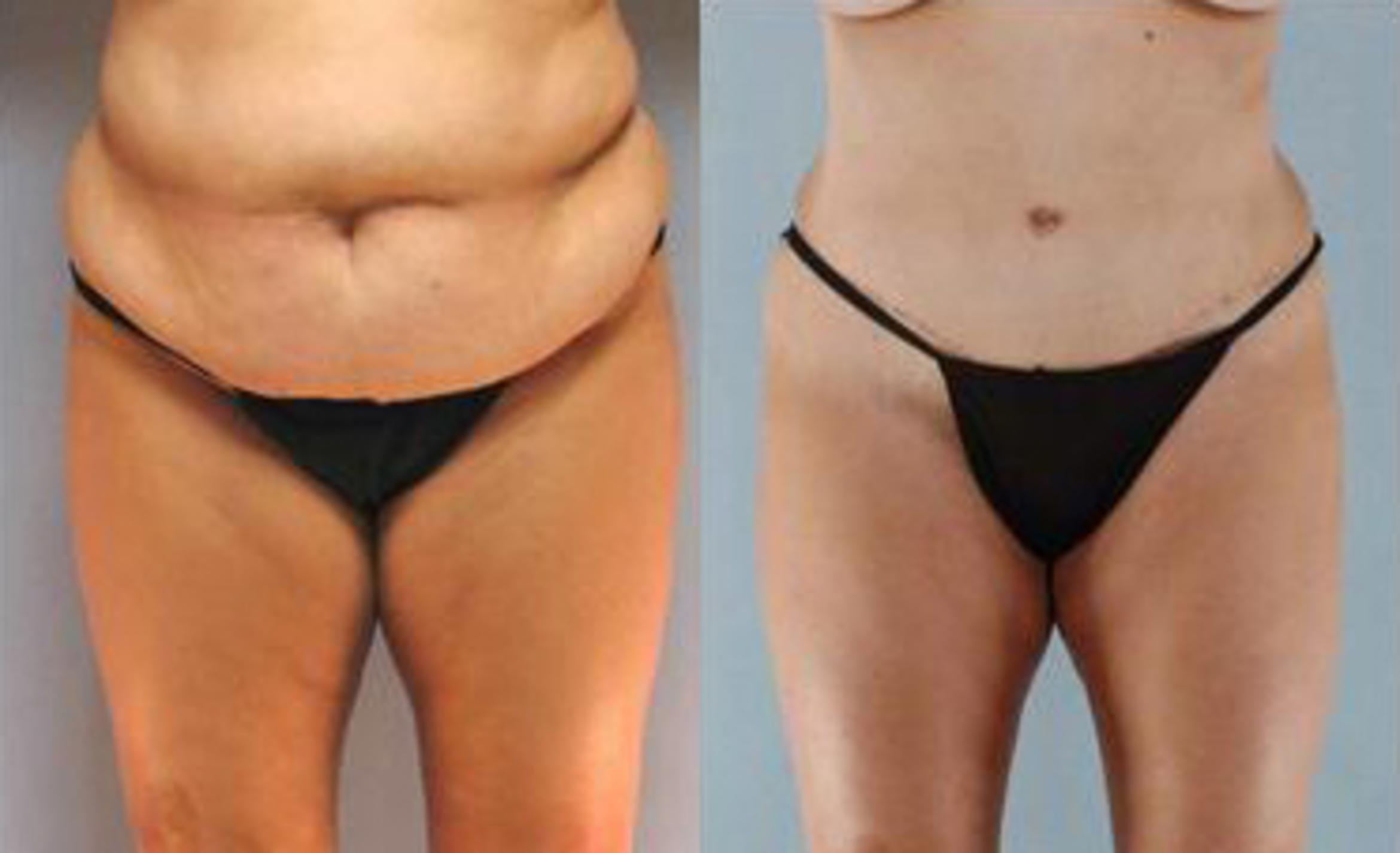 Before & After Liposuction Case 3401 View 1 View in Houston, TX