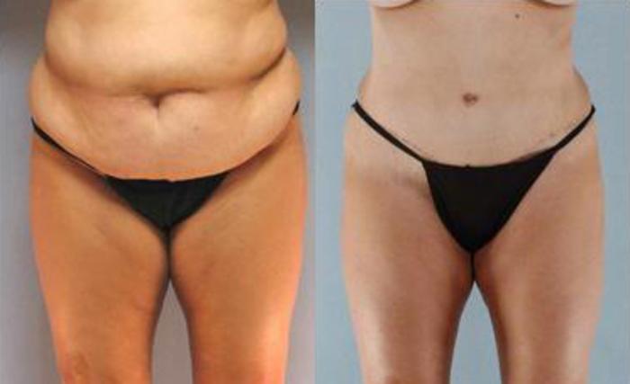 Before & After Liposuction Case 3401 View 1 View in Houston, TX