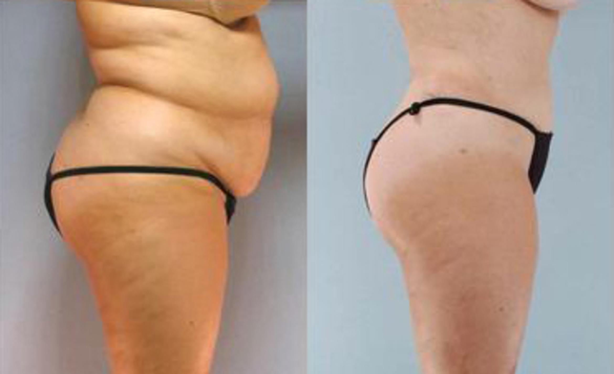 Before & After Liposuction Case 3401 View 3 View in Houston, TX