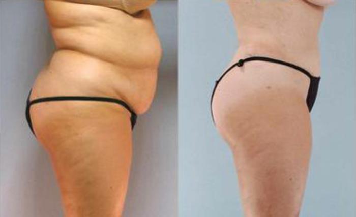 Before & After Liposuction Case 3401 View 3 View in Houston, TX