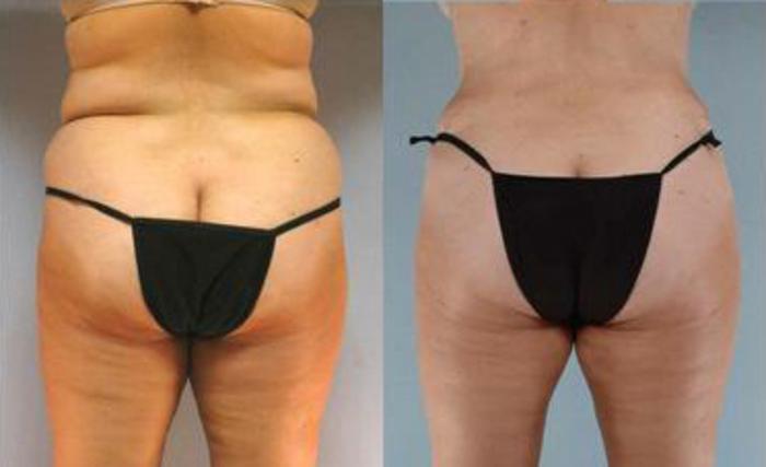 Before & After Liposuction Case 3401 View 4 View in Houston, TX