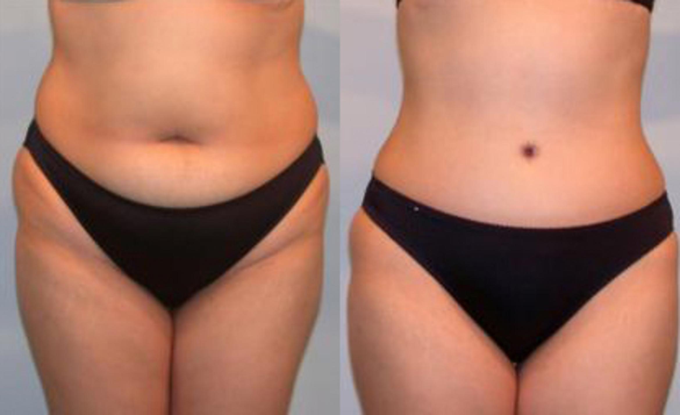 Before & After Liposuction Case 3411 View 1 View in Houston, TX