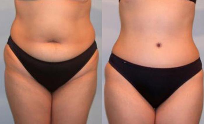 Before & After Liposuction Case 3411 View 1 View in Houston, TX