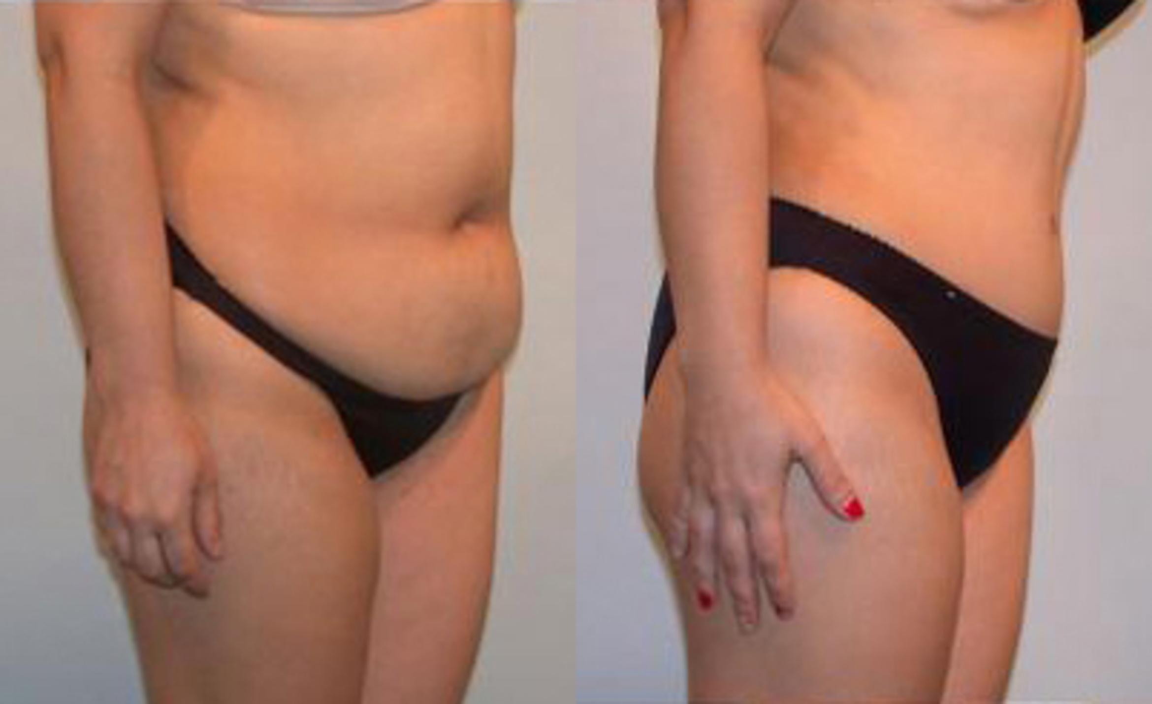 Before & After Liposuction Case 3411 View 2 View in Houston, TX