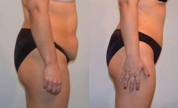 Before & After Liposuction Case 3411 View 3 View in Houston, TX