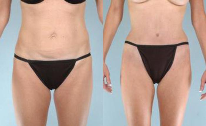 Before & After Liposuction Case 3419 View 1 View in Houston, TX