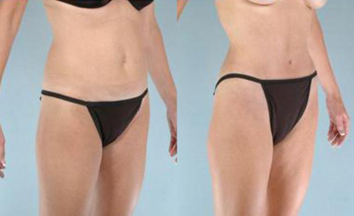 Before & After Liposuction Case 3419 View 2 View in Houston, TX