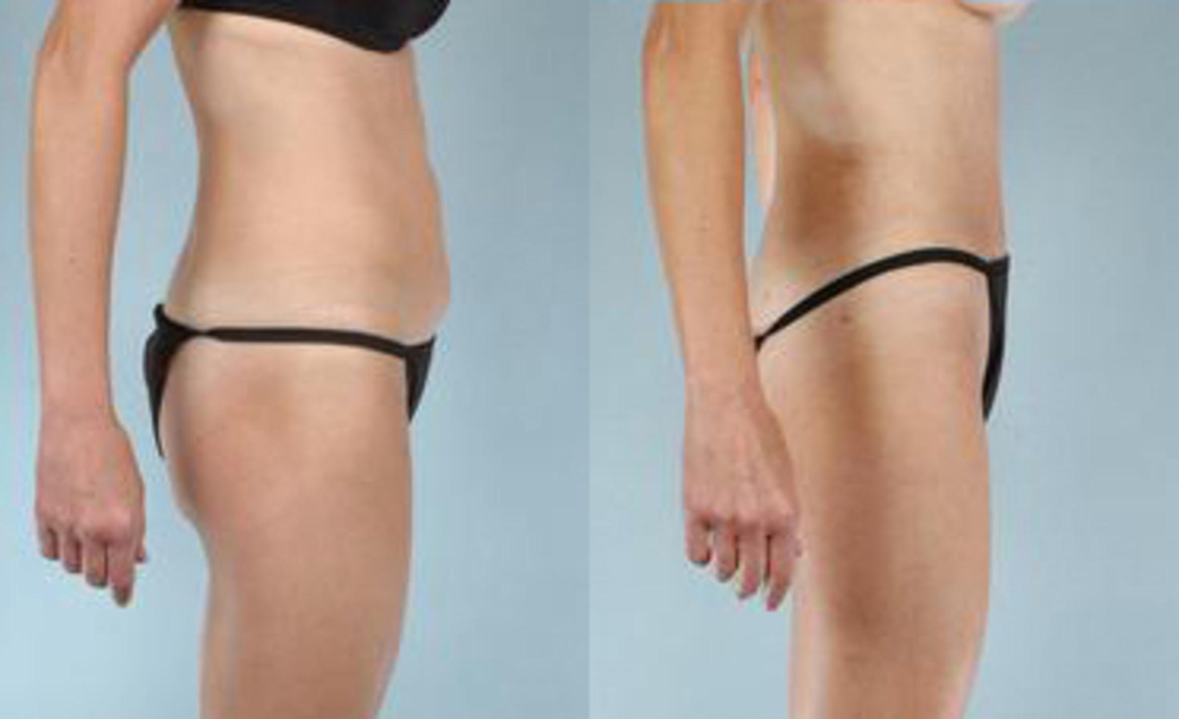 Before & After Liposuction Case 3419 View 3 View in Houston, TX