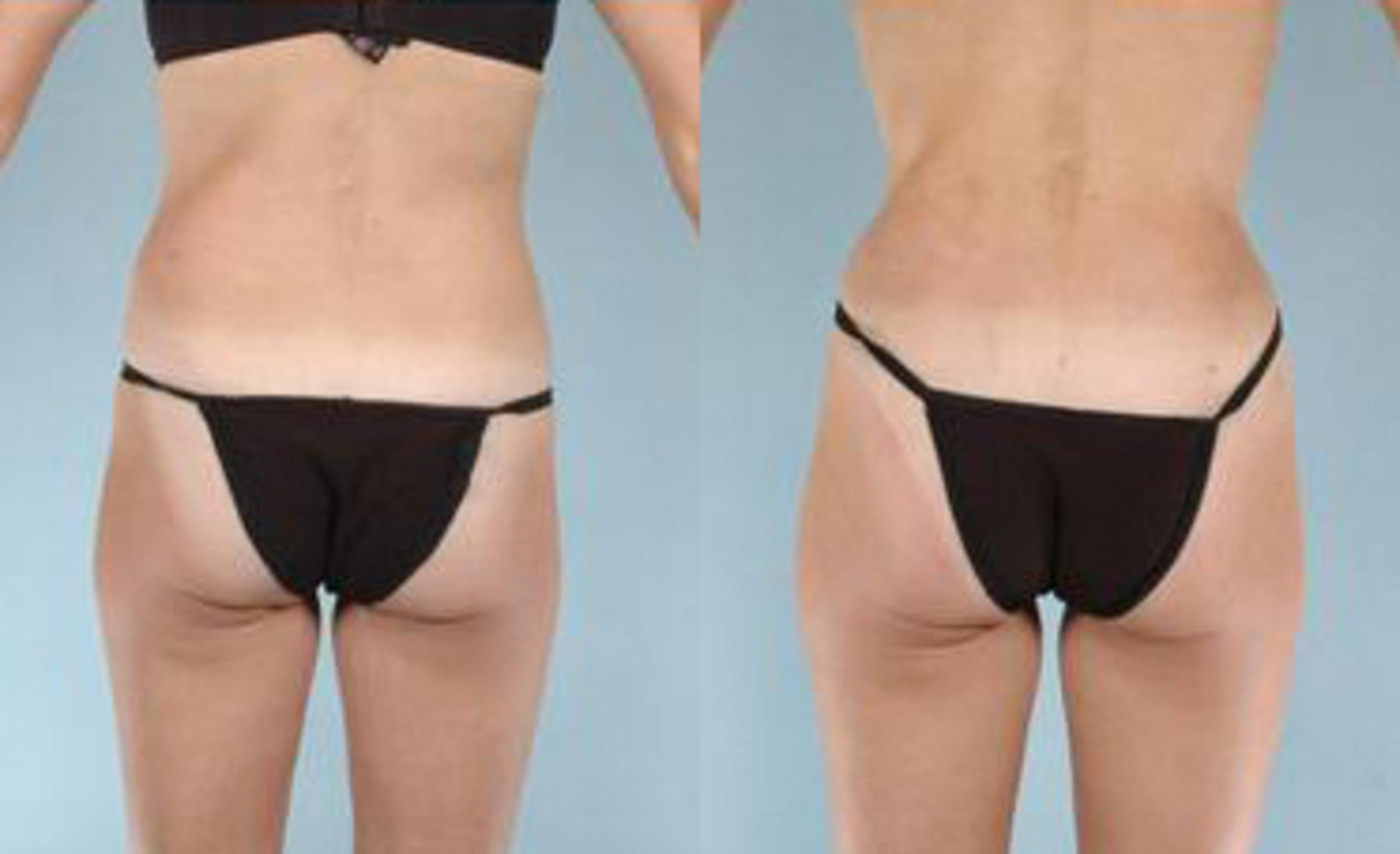 Before & After Liposuction Case 3419 View 4 View in Houston, TX