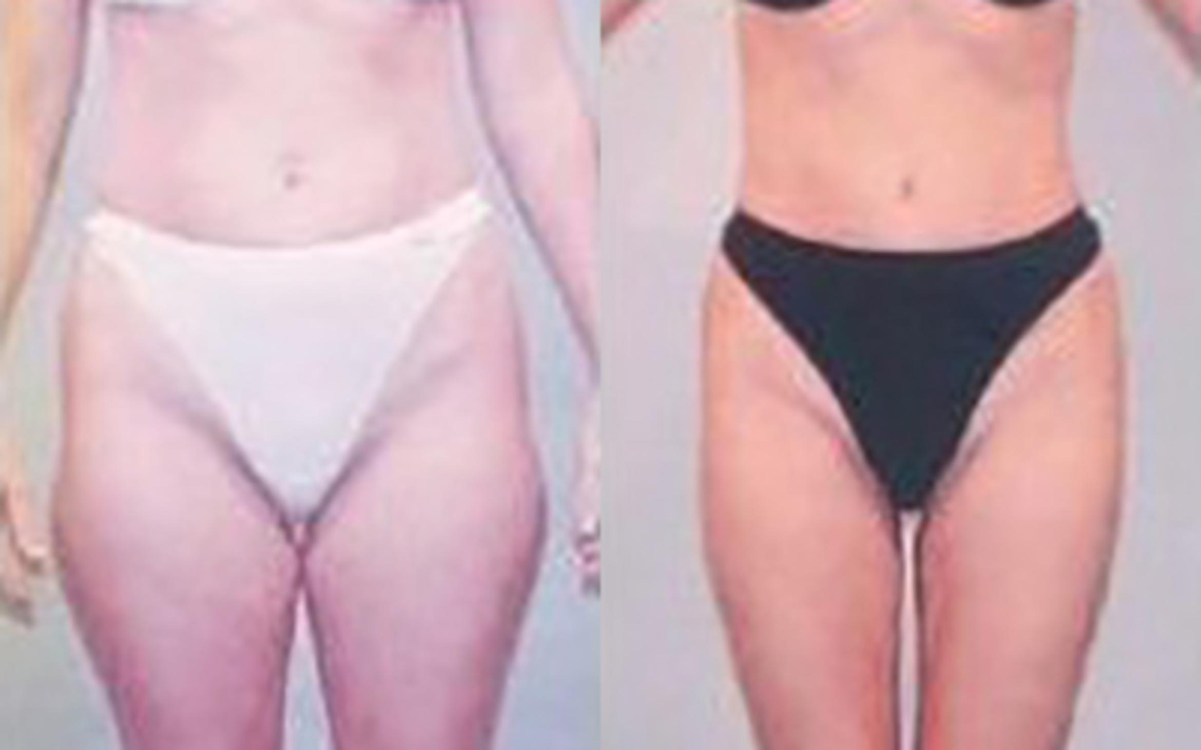 Before & After Liposuction Case 3429 View 1 View in Houston, TX