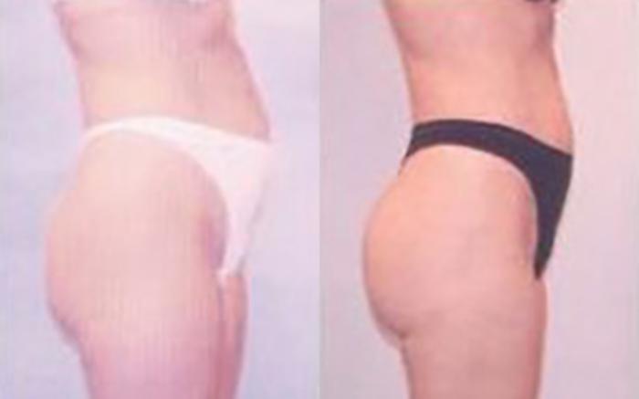 Before & After Liposuction Case 3429 View 2 View in Houston, TX