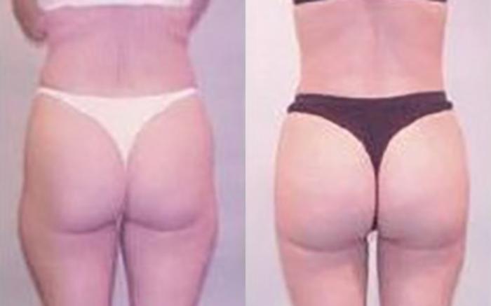 Before & After Liposuction Case 3429 View 3 View in Houston, TX