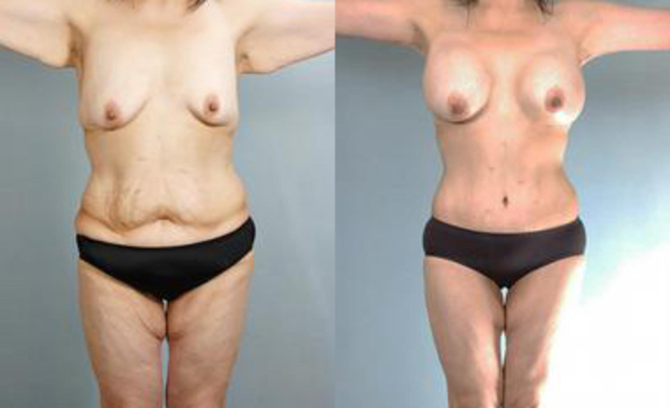Before & After Liposuction Case 3437 View 1 View in Houston, TX