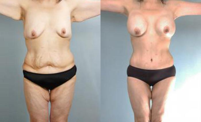 Before & After Liposuction Case 3437 View 1 View in Houston, TX