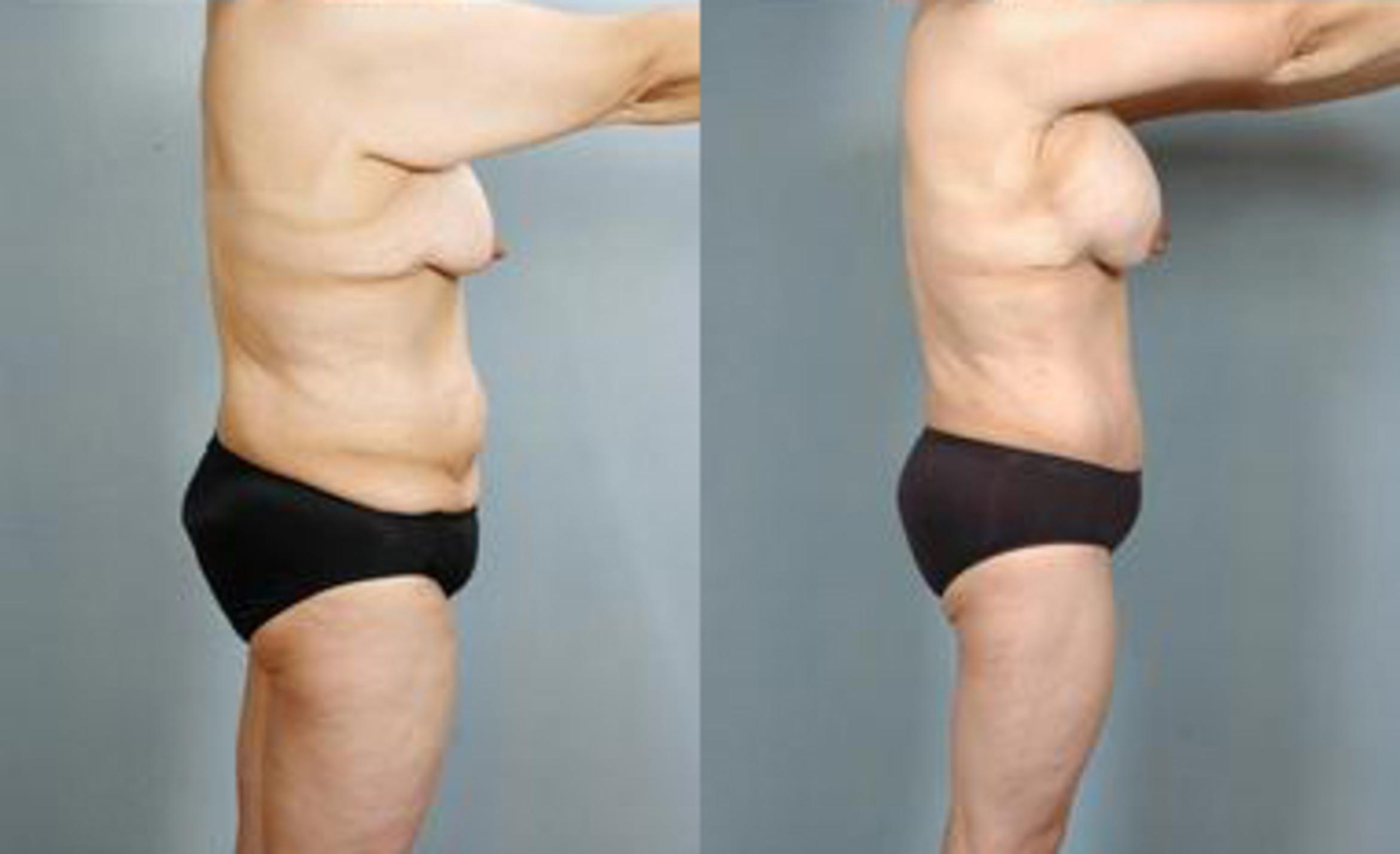 Before & After Liposuction Case 3437 View 3 View in Houston, TX