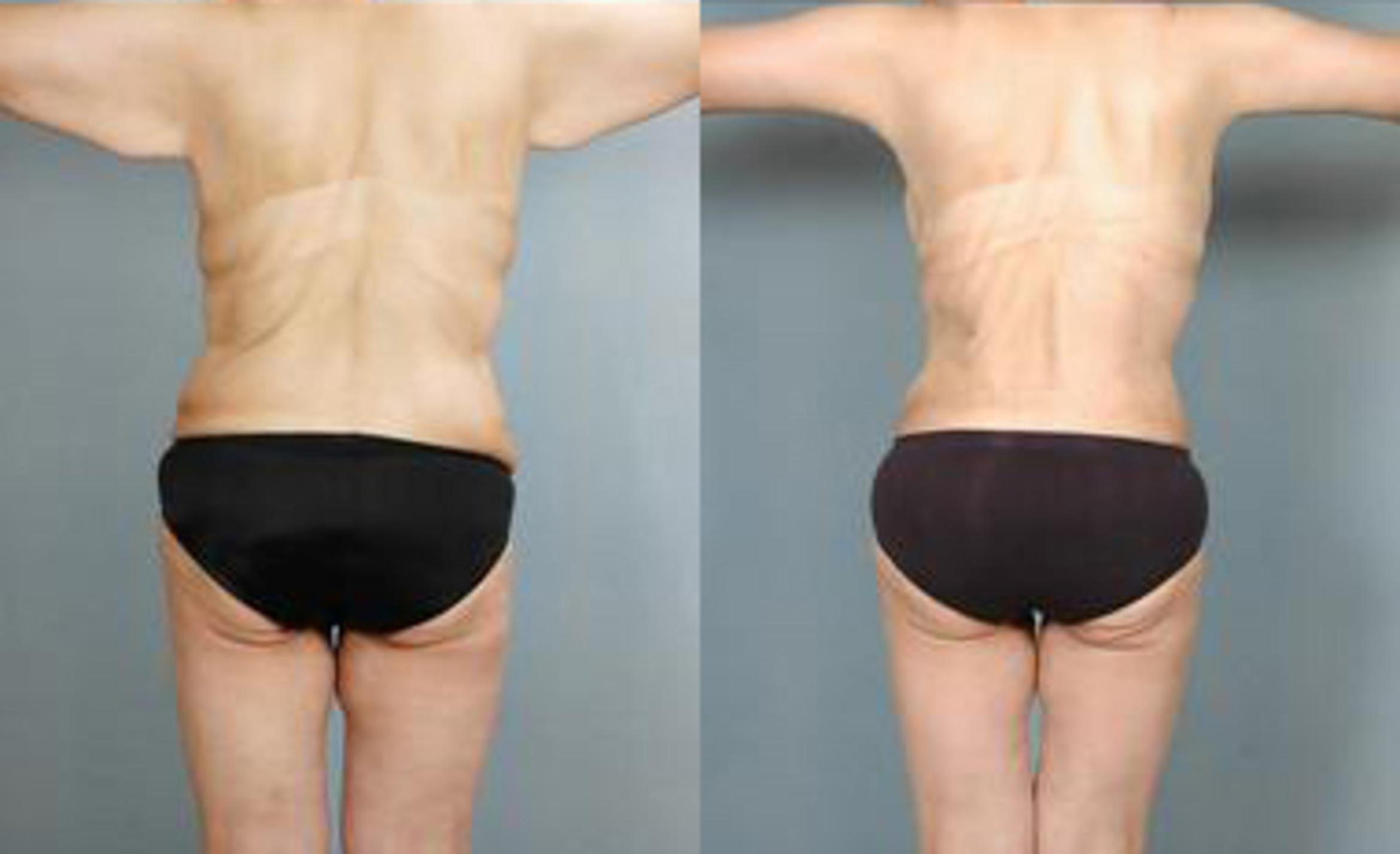Before & After Liposuction Case 3437 View 4 View in Houston, TX
