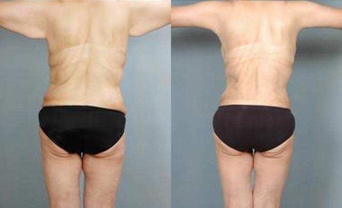 Before & After Liposuction Case 3437 View 4 View in Houston, TX