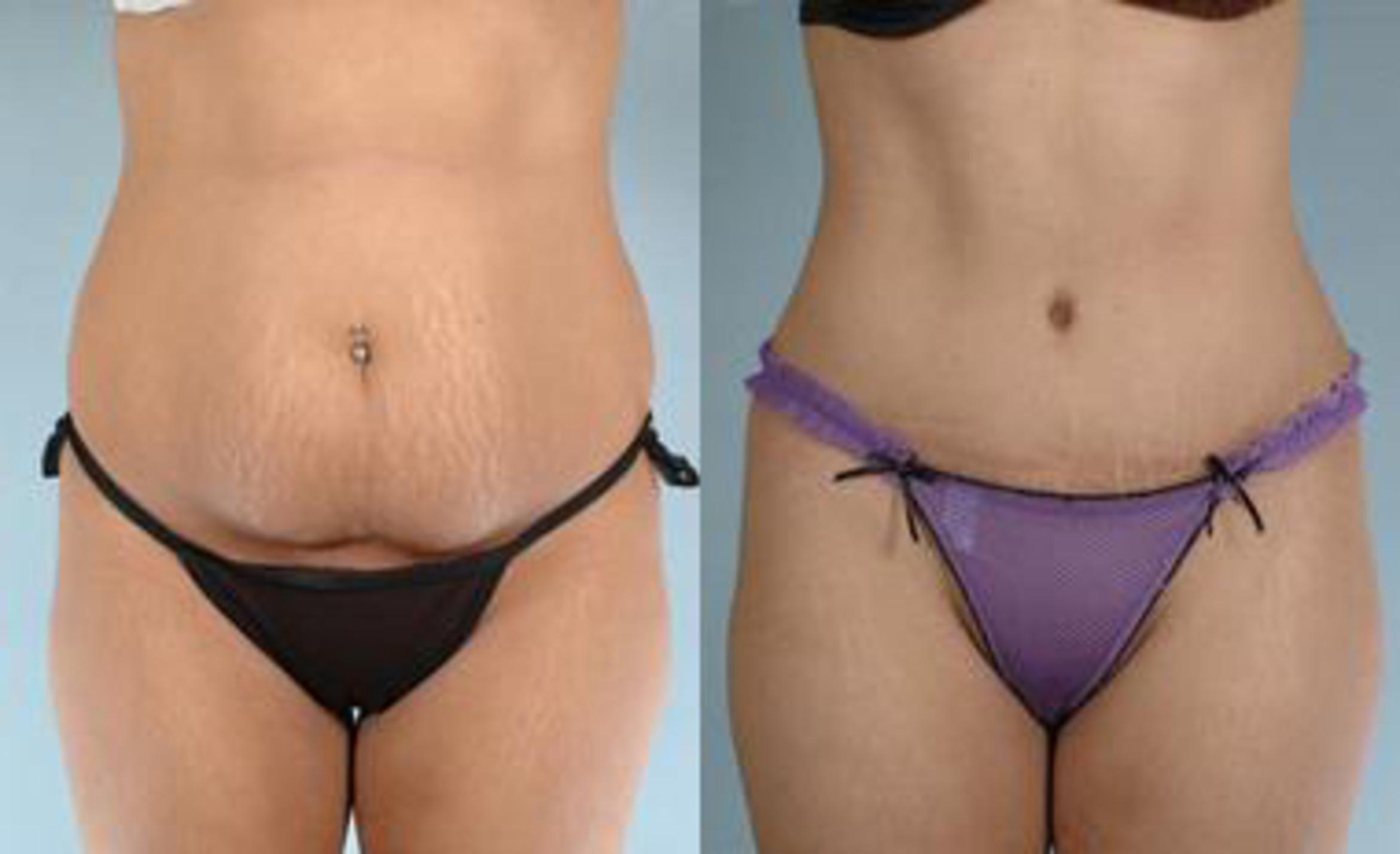 Before & After Liposuction Case 3447 View 1 View in Houston, TX