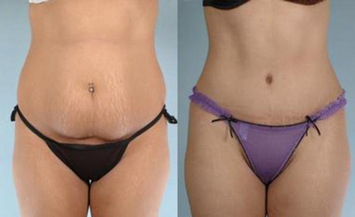 Before & After Liposuction Case 3447 View 1 View in Houston, TX