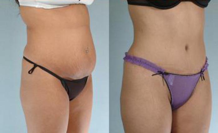 Before & After Liposuction Case 3447 View 2 View in Houston, TX
