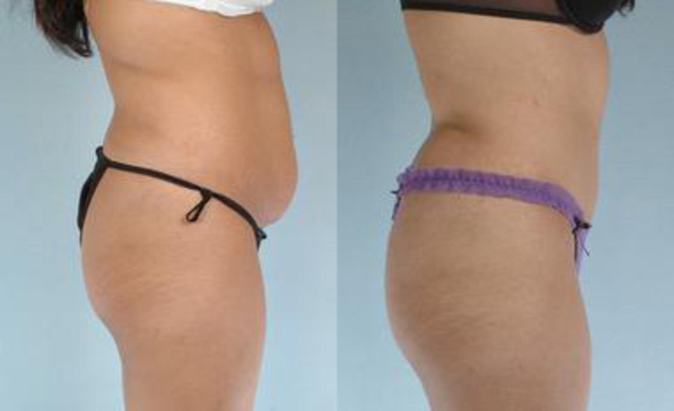 Before & After Liposuction Case 3447 View 3 View in Houston, TX
