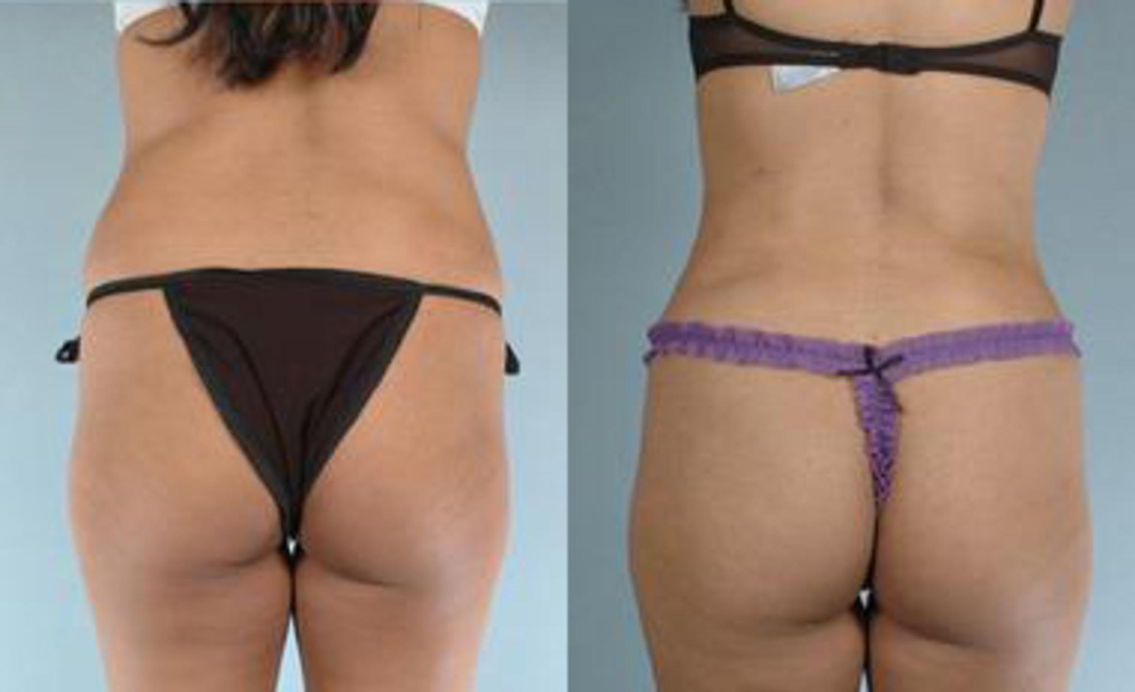 Before & After Liposuction Case 3447 View 4 View in Houston, TX