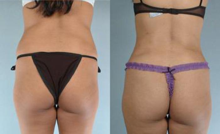 Before & After Liposuction Case 3447 View 4 View in Houston, TX