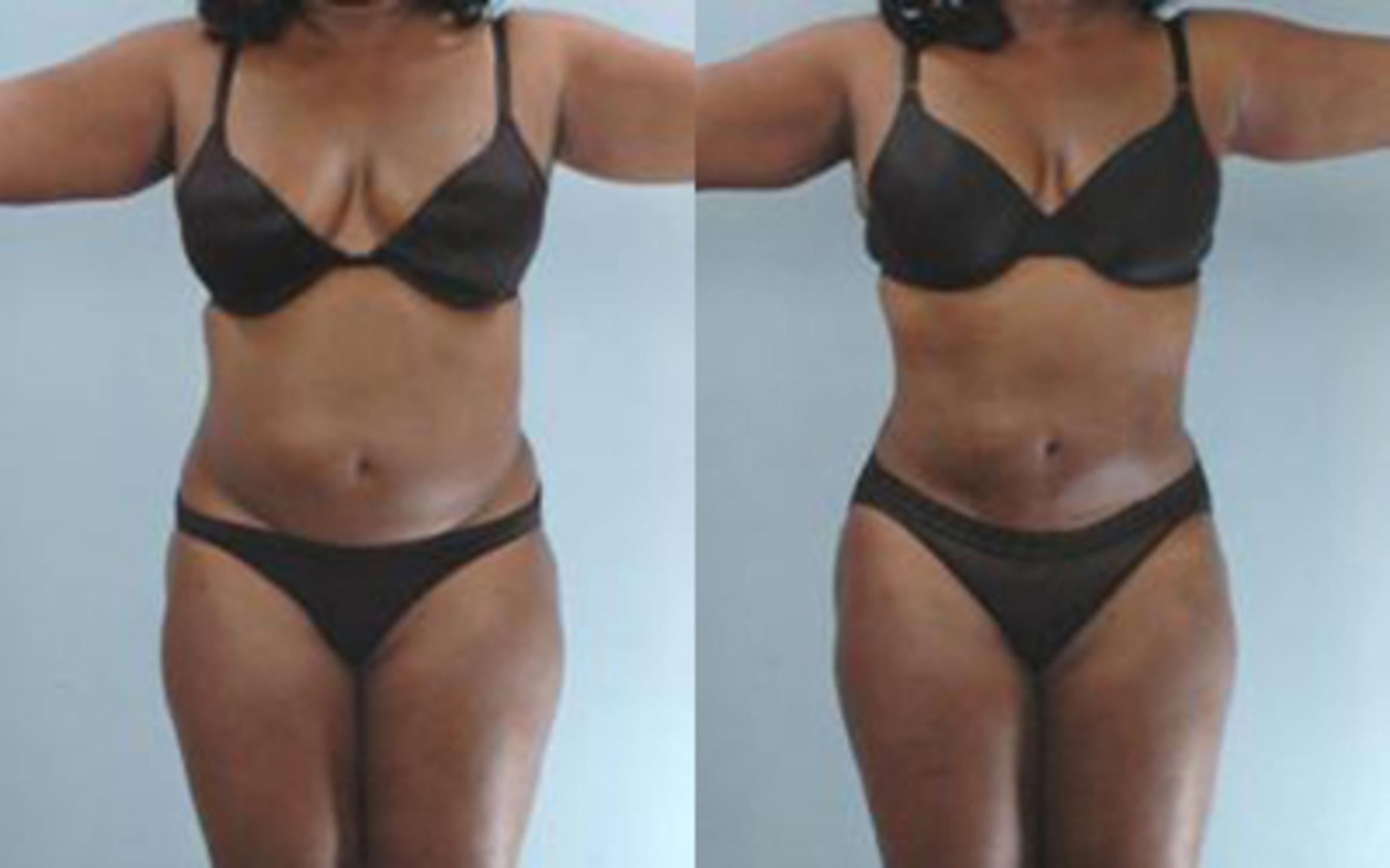 Before & After Liposuction Case 3457 View 1 View in Houston, TX