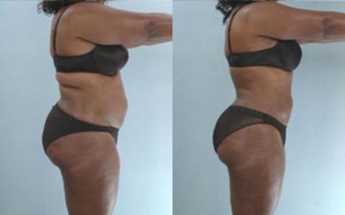 Before & After Liposuction Case 3457 View 2 View in Houston, TX