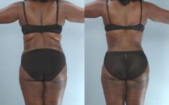 Before & After Liposuction Case 3457 View 3 View in Houston, TX