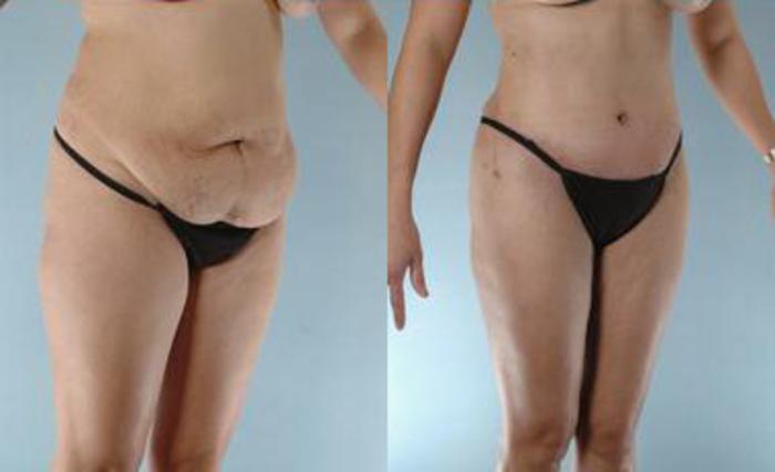Before & After Liposuction Case 3465 View 2 View in Houston, TX