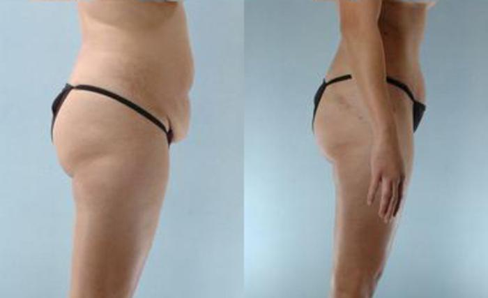 Before & After Liposuction Case 3465 View 3 View in Houston, TX