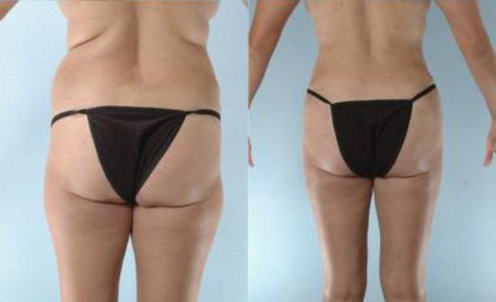 Before & After Liposuction Case 3465 View 4 View in Houston, TX