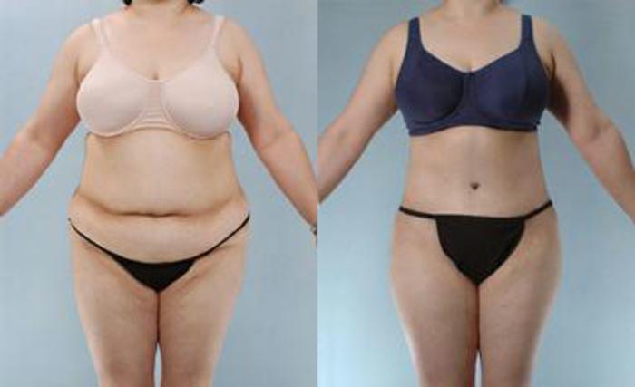 Before & After Liposuction Case 3475 View 1 View in Houston, TX