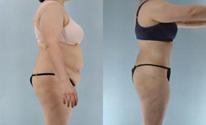 Before & After Liposuction Case 3475 View 3 View in Houston, TX
