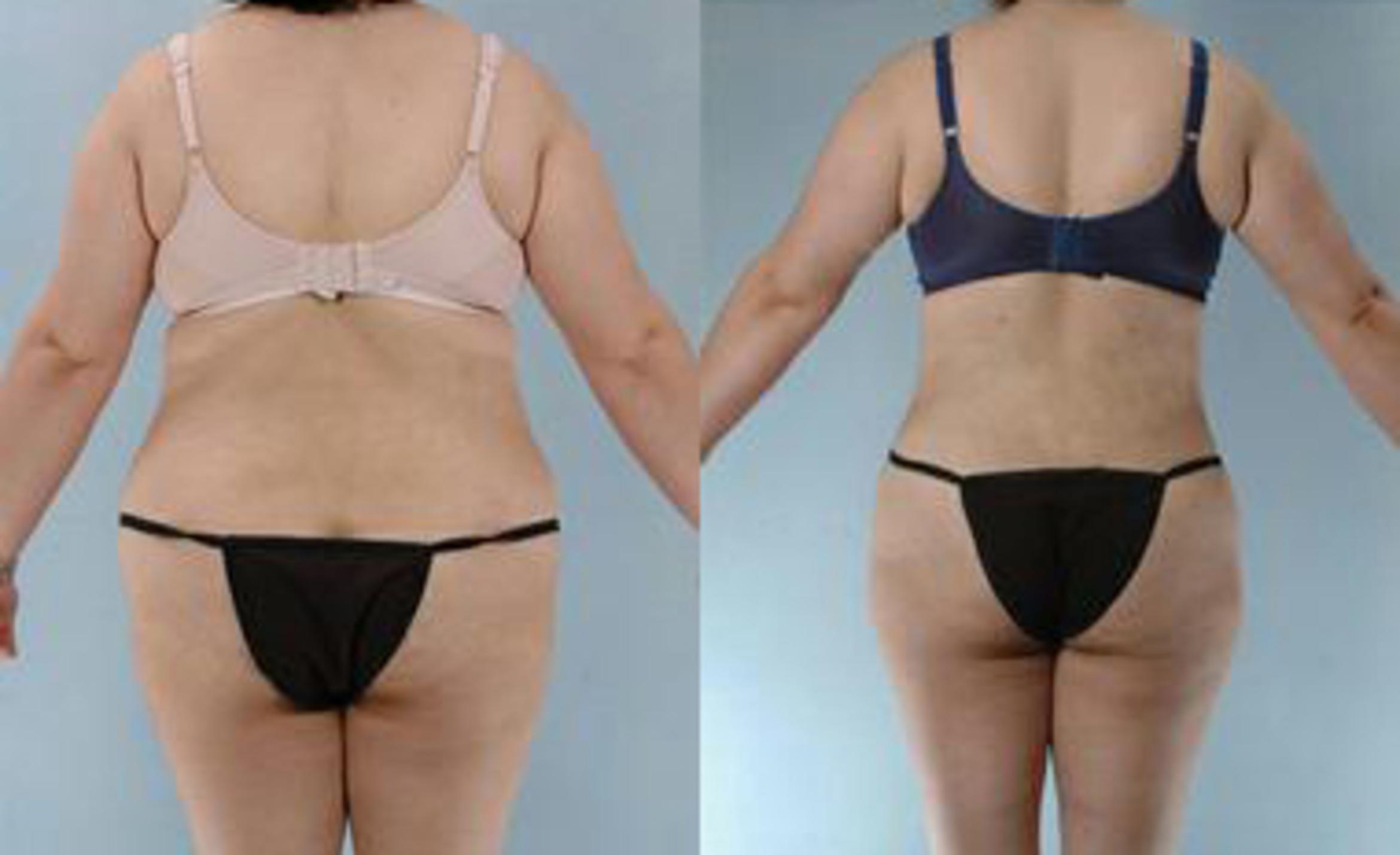 Before & After Liposuction Case 3475 View 4 View in Houston, TX