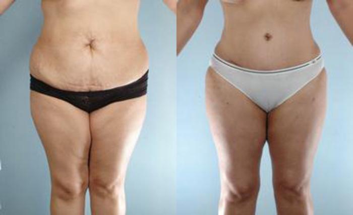 Before & After Liposuction Case 3485 View 1 View in Houston, TX