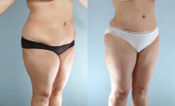 Before & After Liposuction Case 3485 View 2 View in Houston, TX