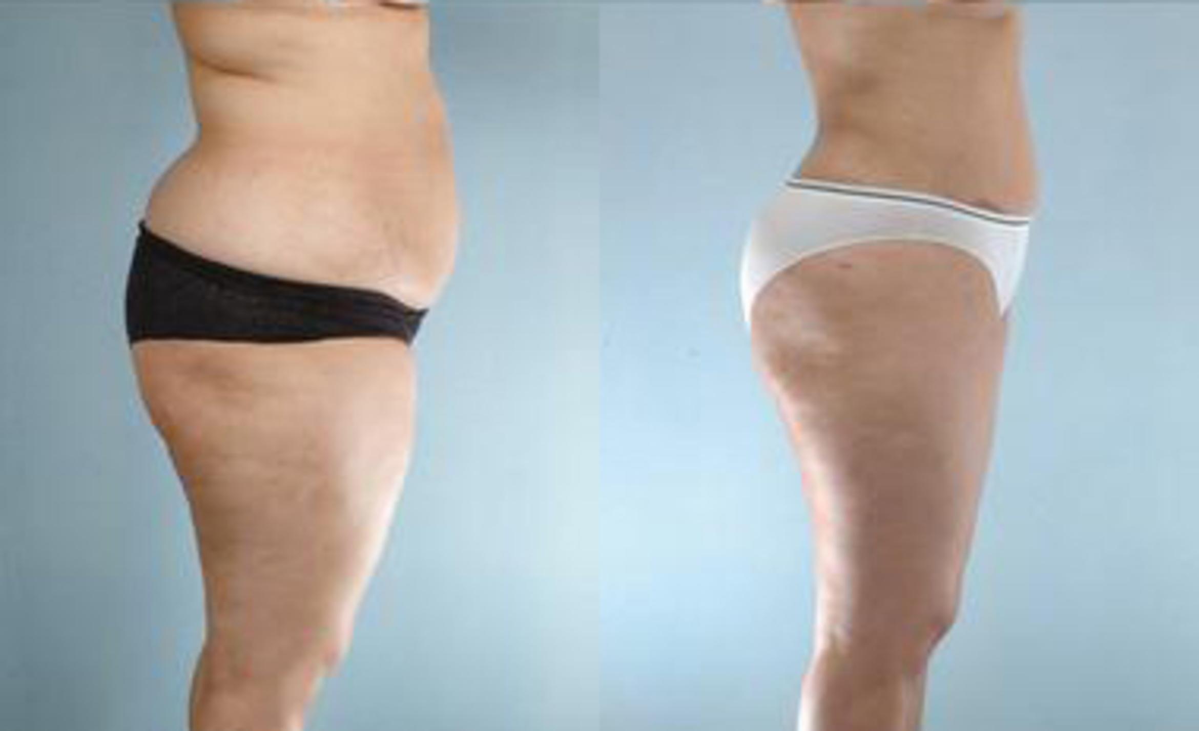 Before & After Liposuction Case 3485 View 3 View in Houston, TX