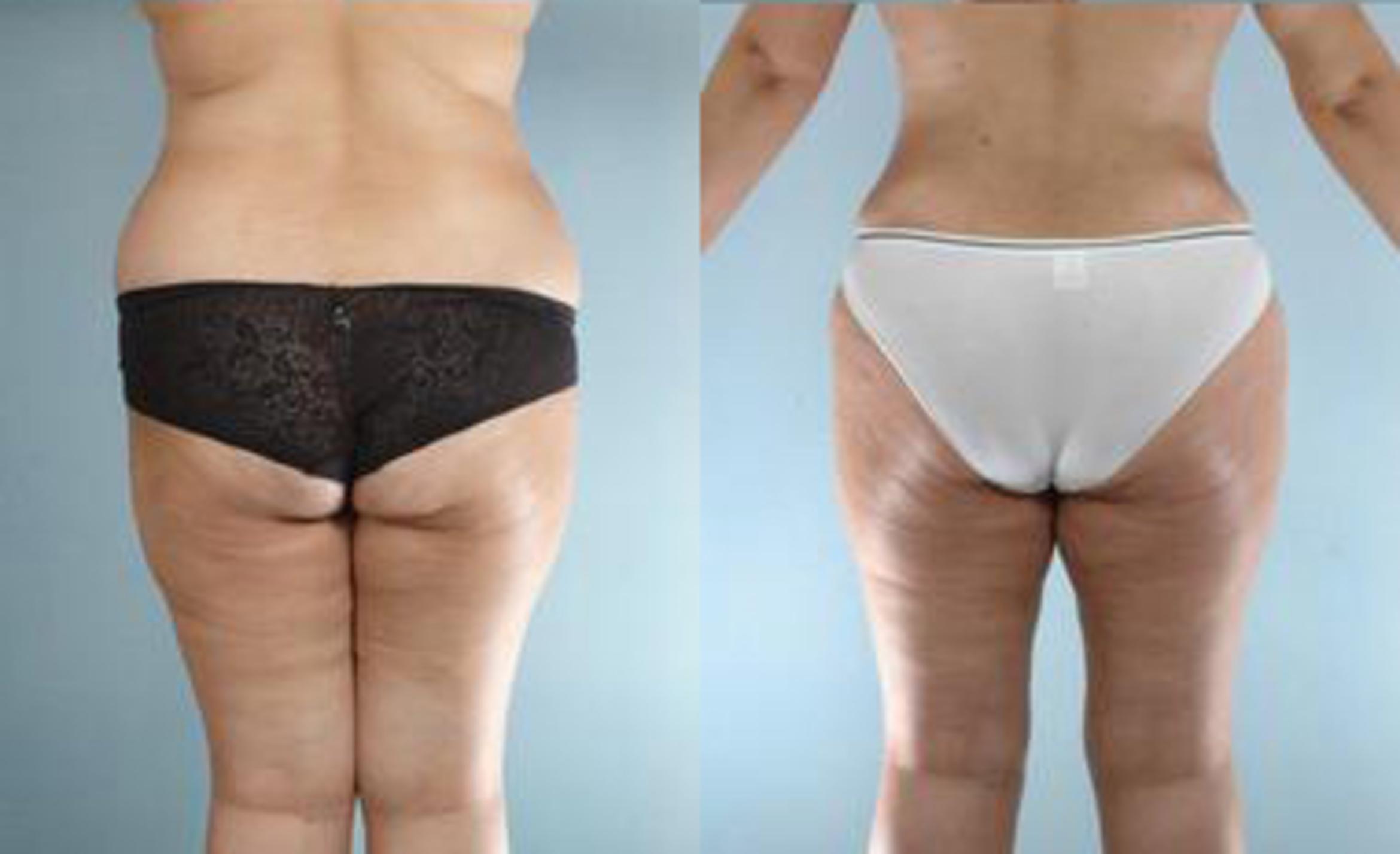Before & After Liposuction Case 3485 View 4 View in Houston, TX