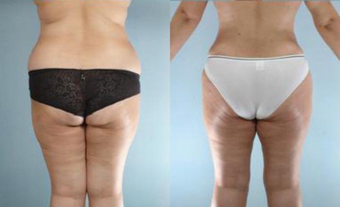 Before & After Liposuction Case 3485 View 4 View in Houston, TX