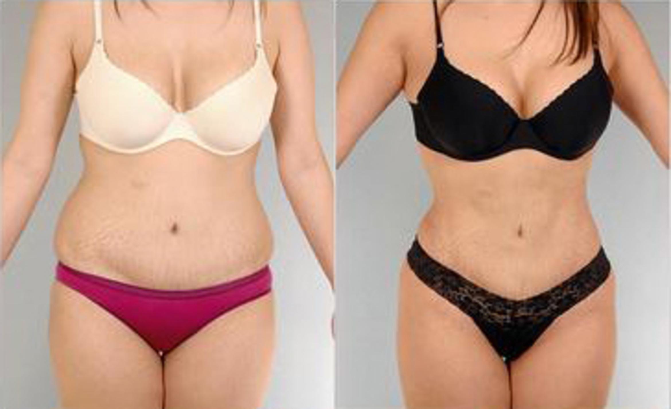 Before & After Liposuction Case 3495 View 1 View in Houston, TX