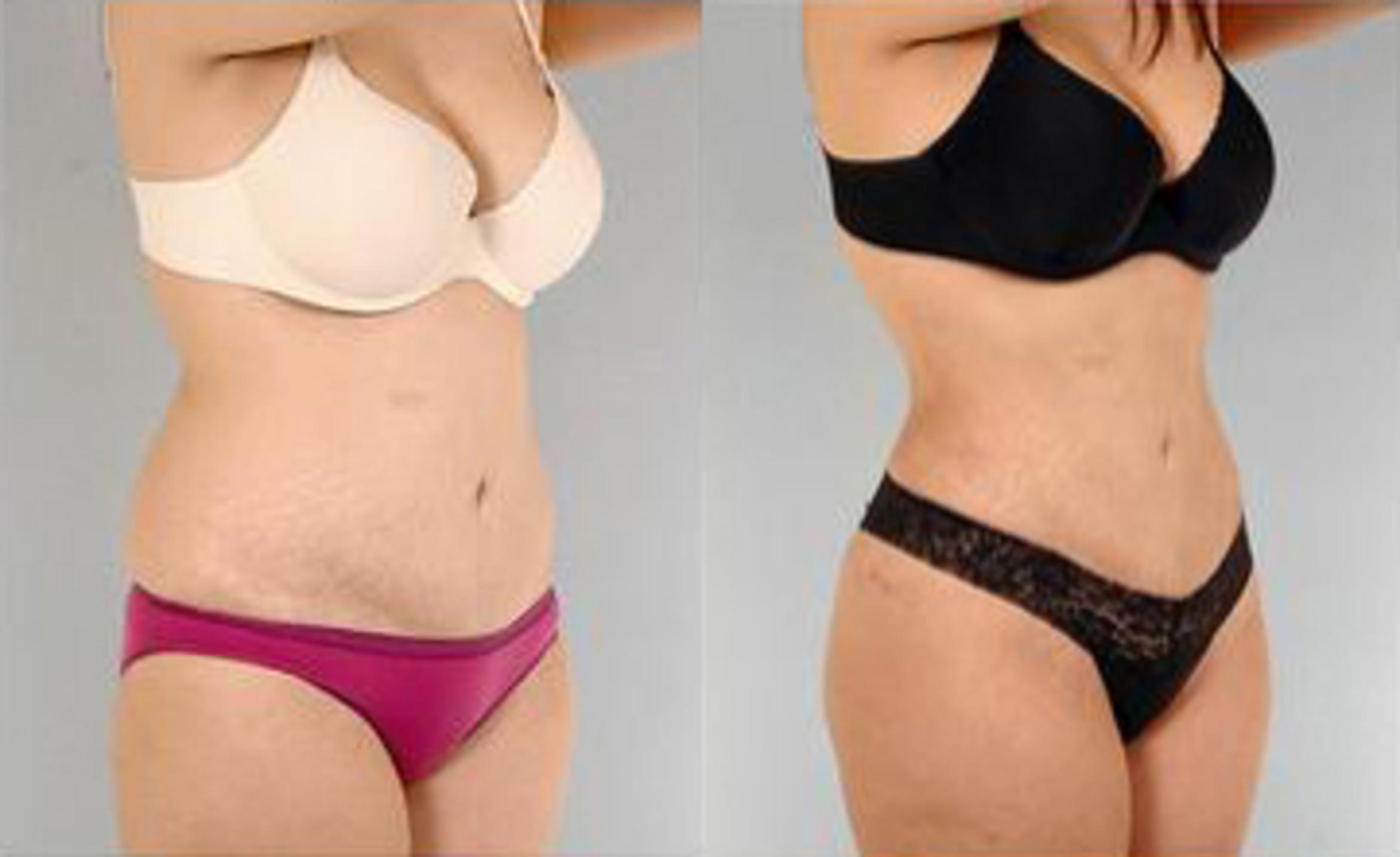 Before & After Liposuction Case 3495 View 2 View in Houston, TX