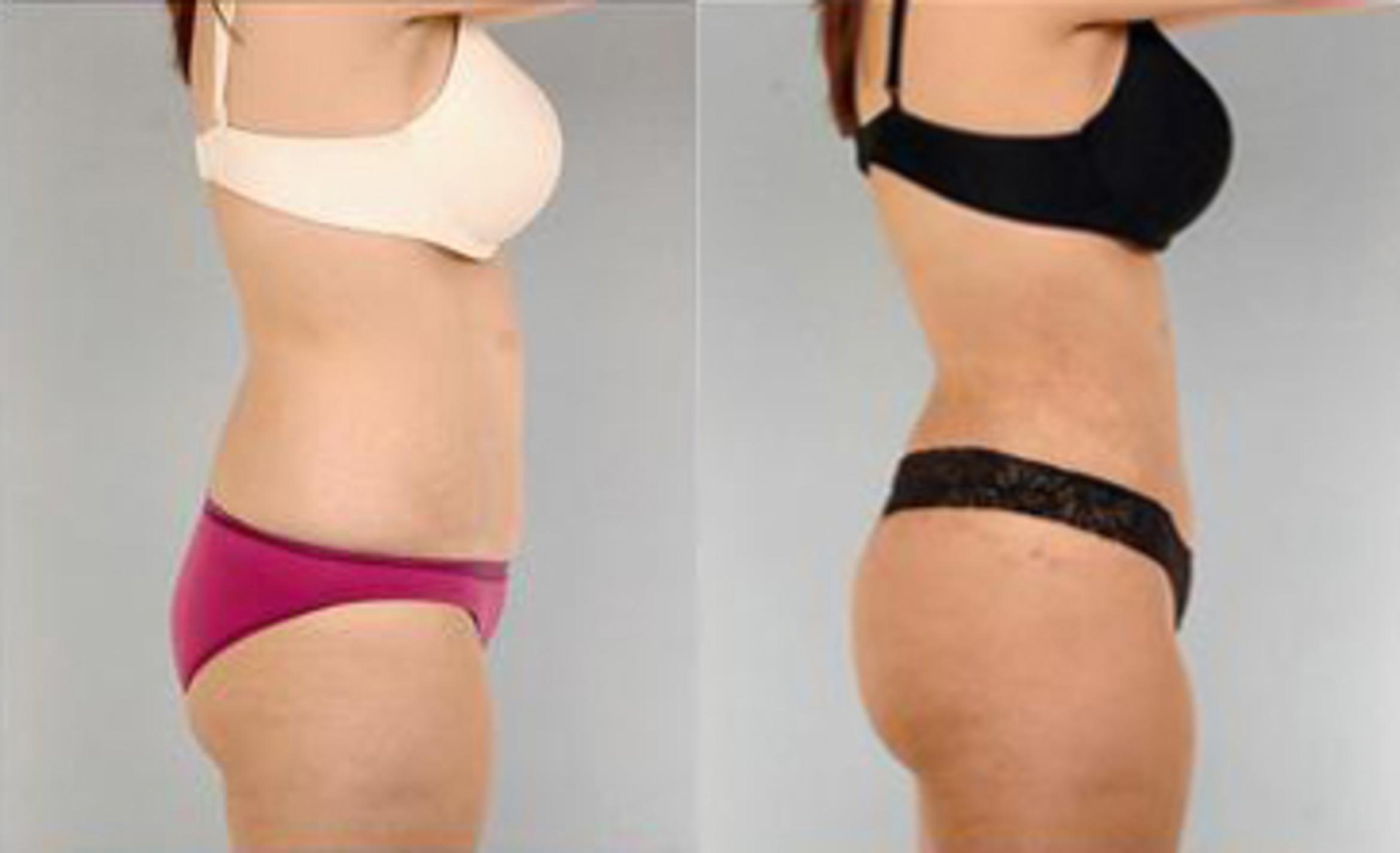 Before & After Liposuction Case 3495 View 3 View in Houston, TX