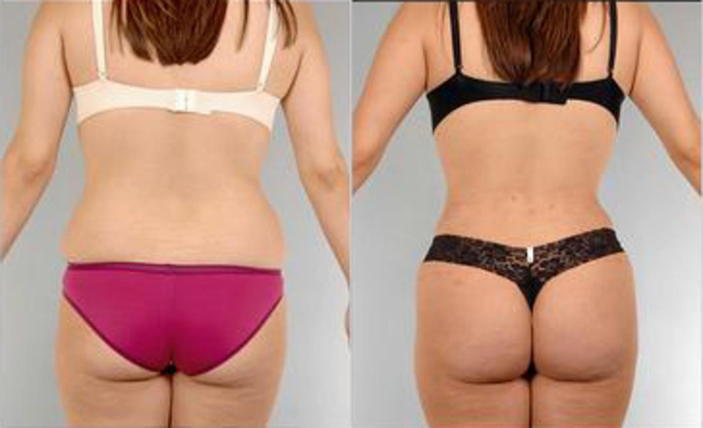 Before & After Liposuction Case 3495 View 4 View in Houston, TX