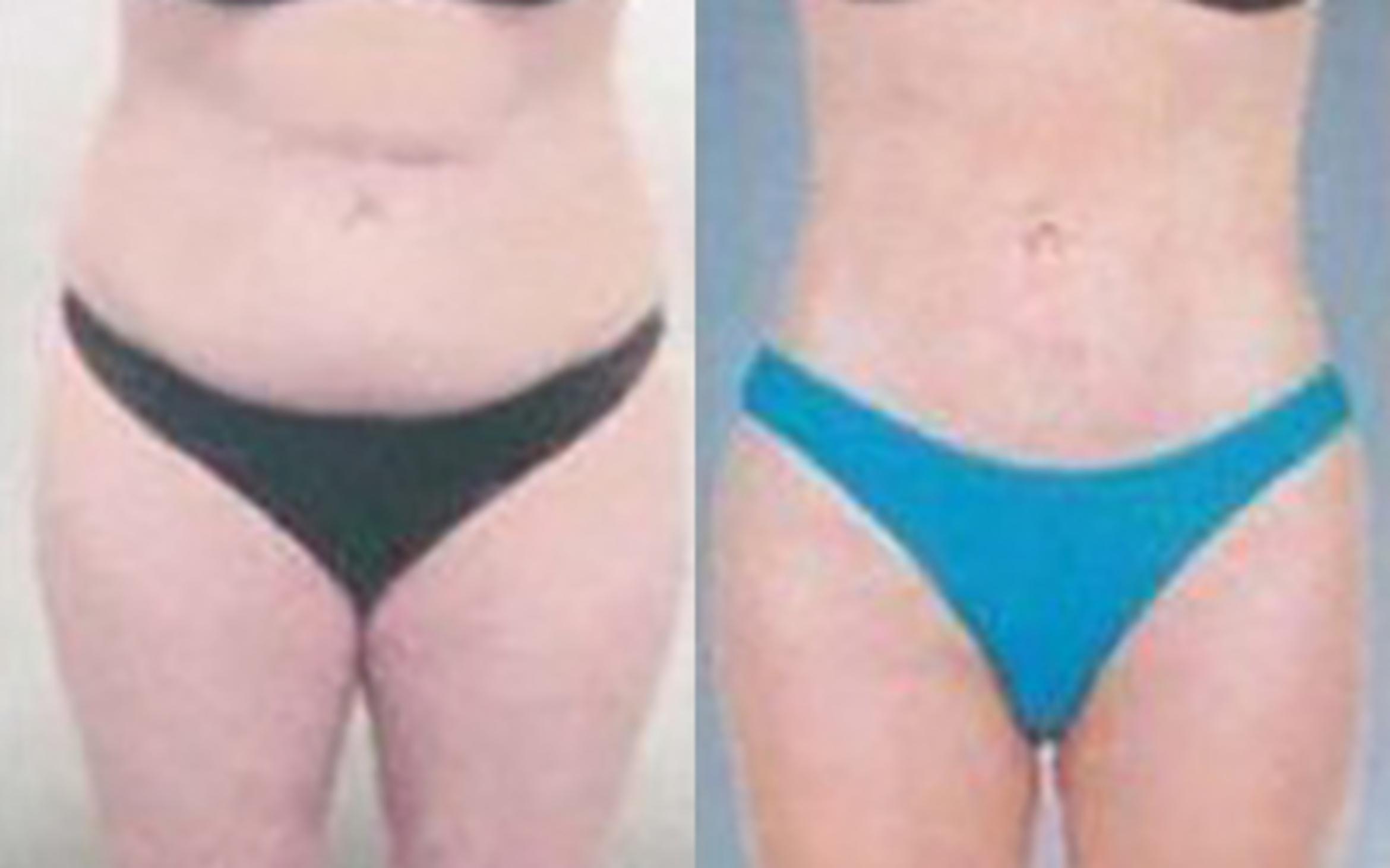 Before & After Liposuction Case 3505 View 1 View in Houston, TX